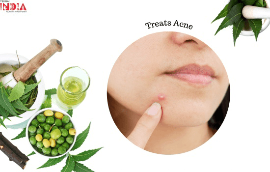 Neem Treats Acne