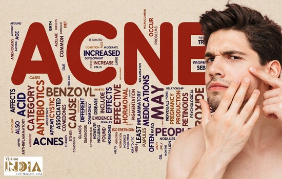 Causes of Acne