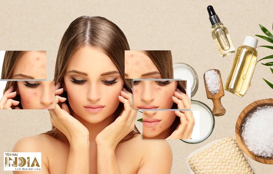 Natural Ways To Overcome Acne